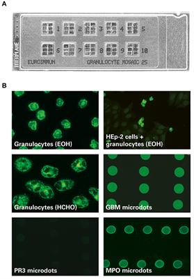 Corrigendum: Autoantibodies in renal diseases – clinical significance and recent developments in serological detection